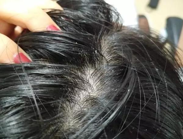 5大表现看出头上长螨虫,3招就把它除光不留余地|螨虫|头皮|头发_新浪