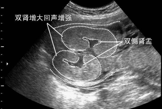 b超单子判断男女, 据说看到这几个字, 百分之九十是男宝!