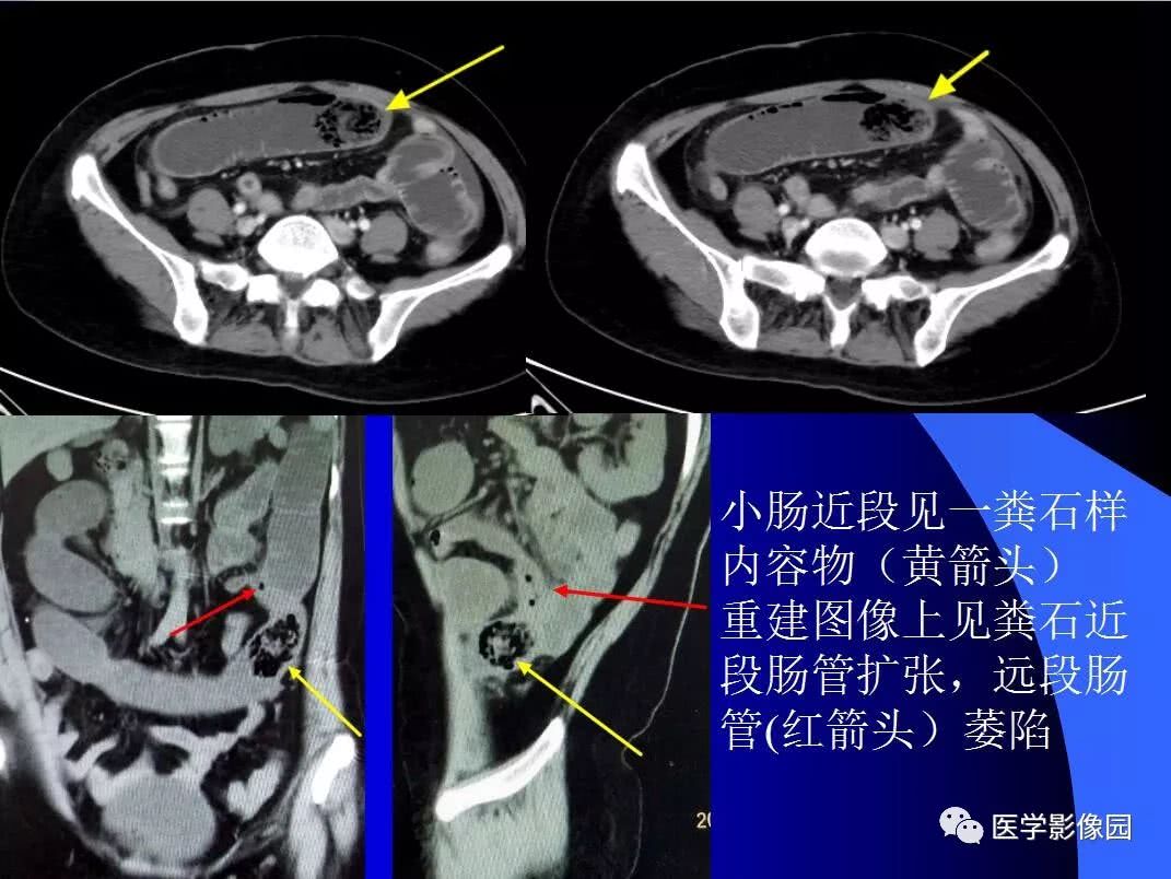 小肠梗阻,等你分析|梗阻|小肠|医学影像_新浪新闻