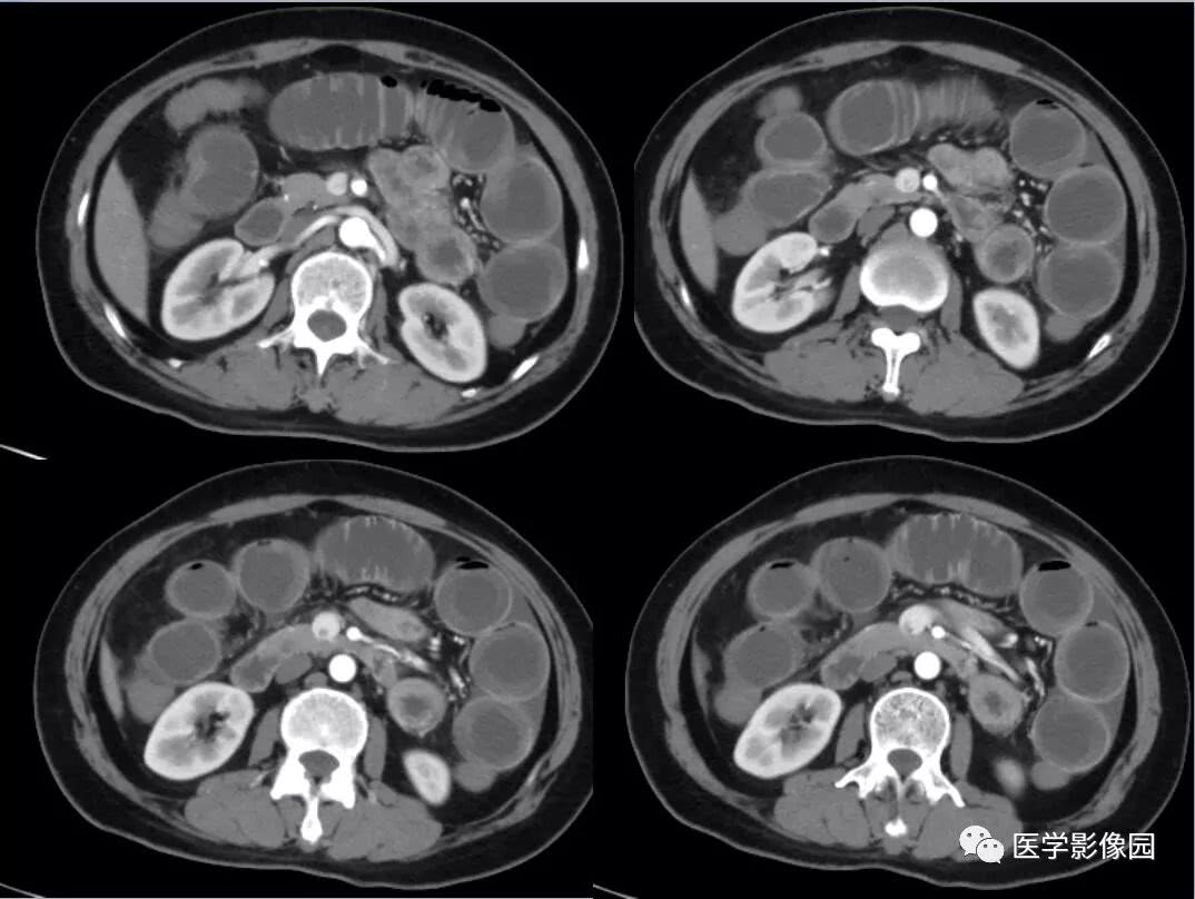 小肠梗阻等你分析
