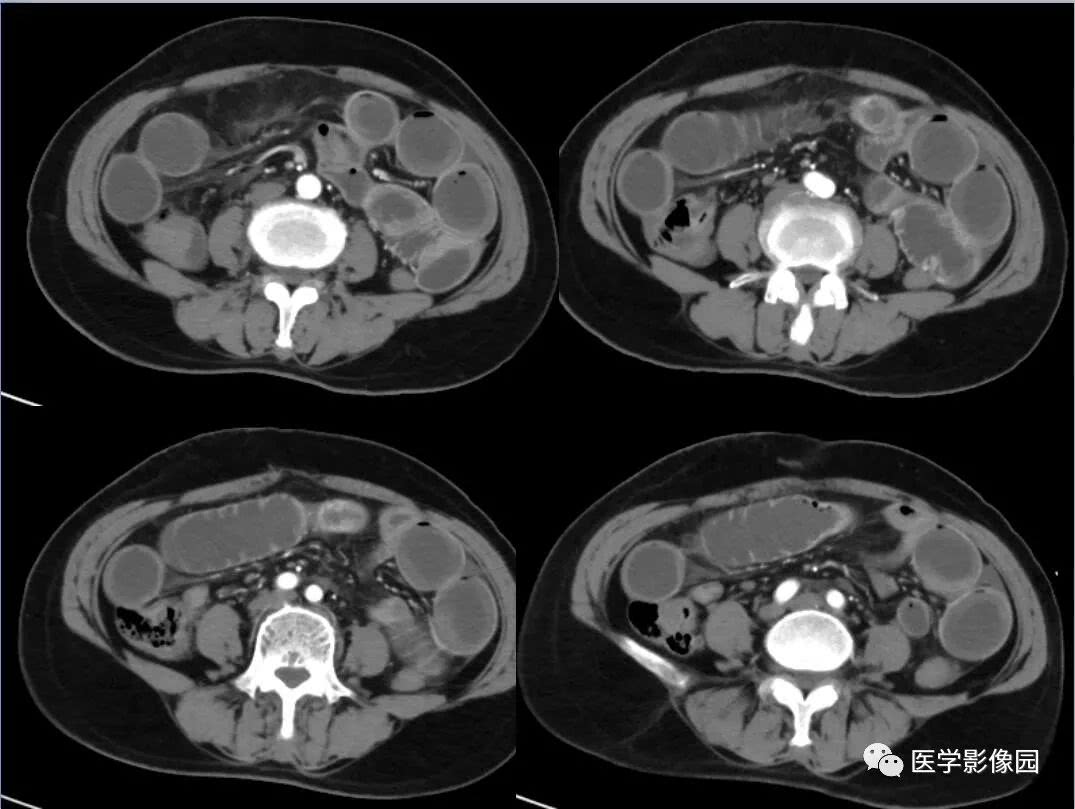 小肠梗阻等你分析
