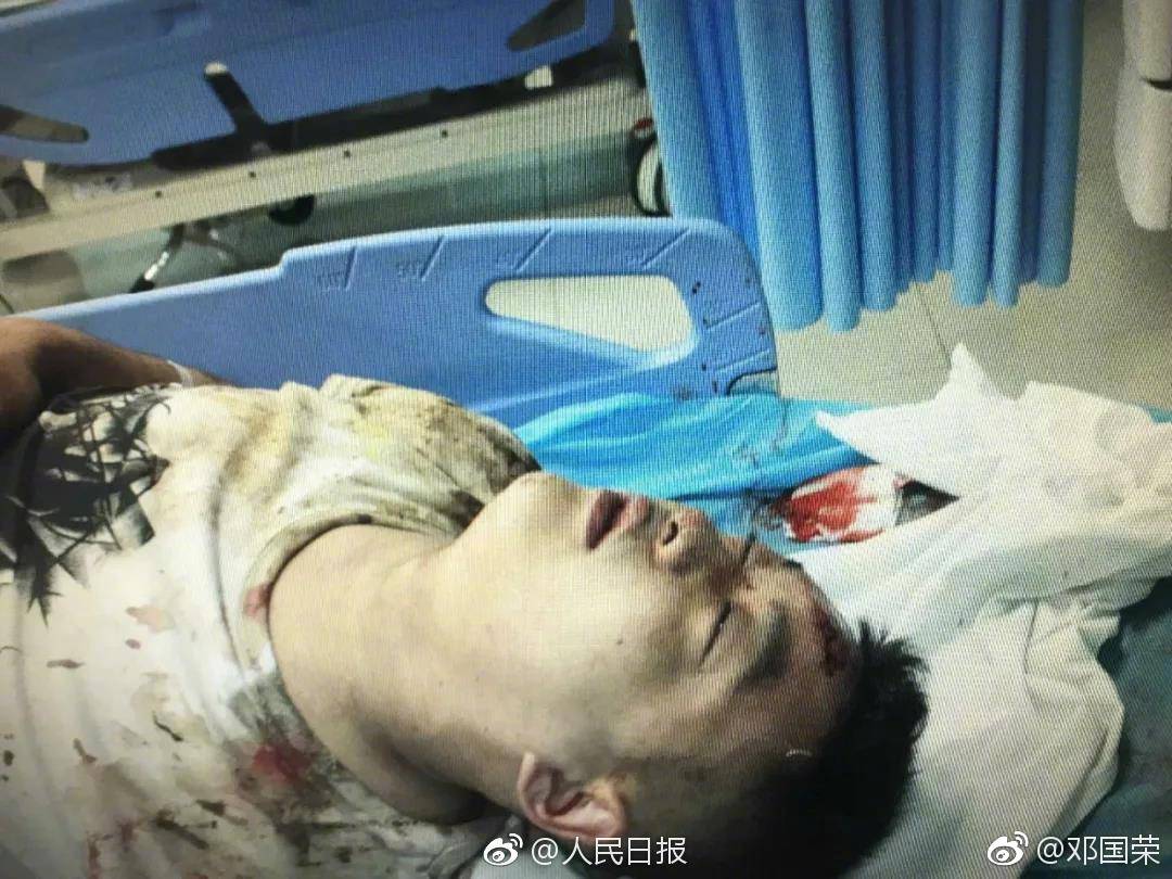 杭州24岁小伙颅内损伤,现在重症监护室