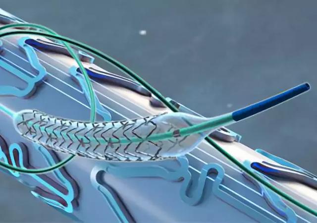 靶向洗脱支架系统已经是微创医疗产品线中,继火鸟(firebird)与火鸟 2