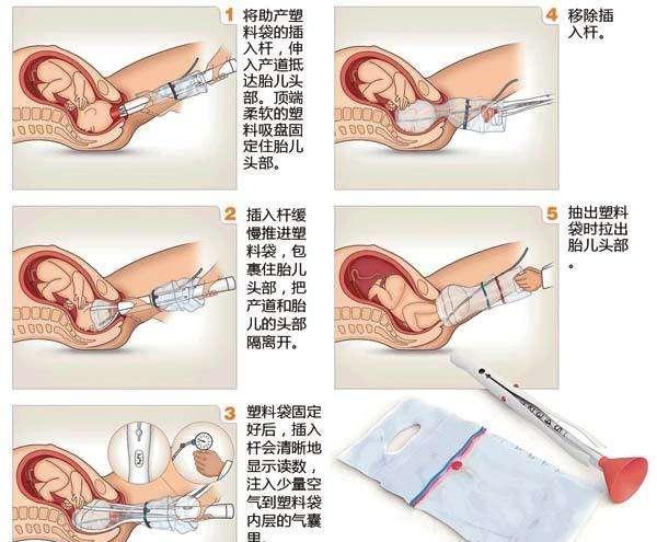 当时医生在产房门口:使用产钳是有危险的,如果幸运宝宝会安然无恙