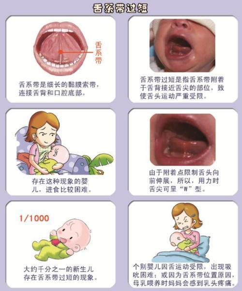 当妈后,你仔细观察过娃的舌头吗?尤其是那根筋!|舌系带|舌头|宝宝_新浪新闻