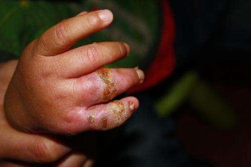 2岁宝宝手部化脓感染啼哭不止, 家里有这东西的要注意了!