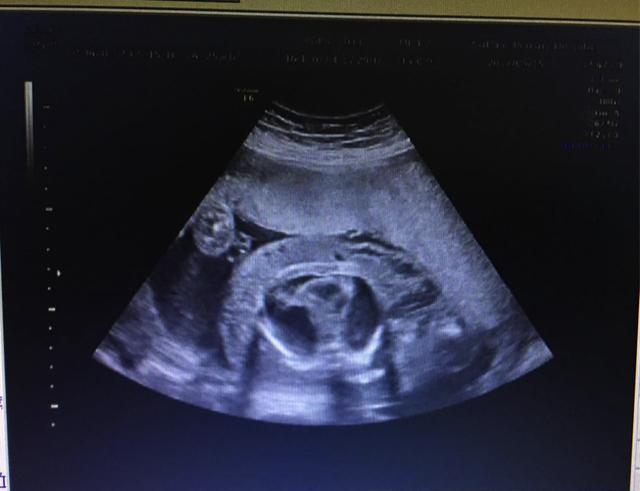孕26周的肚子竟如足月大,准妈妈被迫引产|准妈妈|蔡丽|胎儿_新浪新闻
