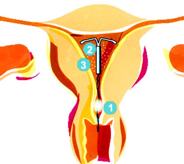 不过,就在取出孩子的那一刻,小姑子也发现了一只避孕环.