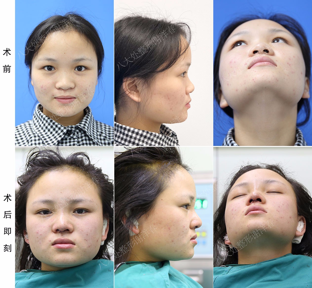 90后小姐姐的鞍鼻改造记(附图)|90后|鼻尖整形|小姐姐_新浪新闻