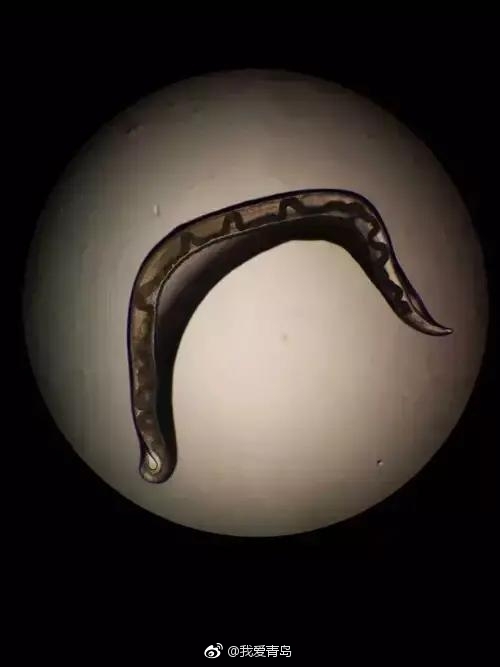 青岛一7岁男童眼睛红肿两月医生拽出4条虫!全因干了这件事[允悲]