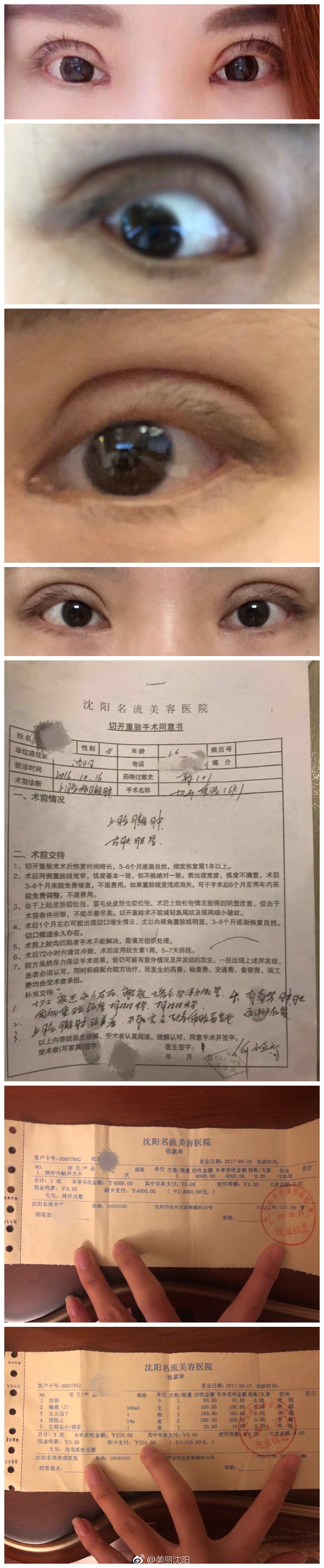 双爆料!沈阳名流整形医院 双眼皮手术导致毁容