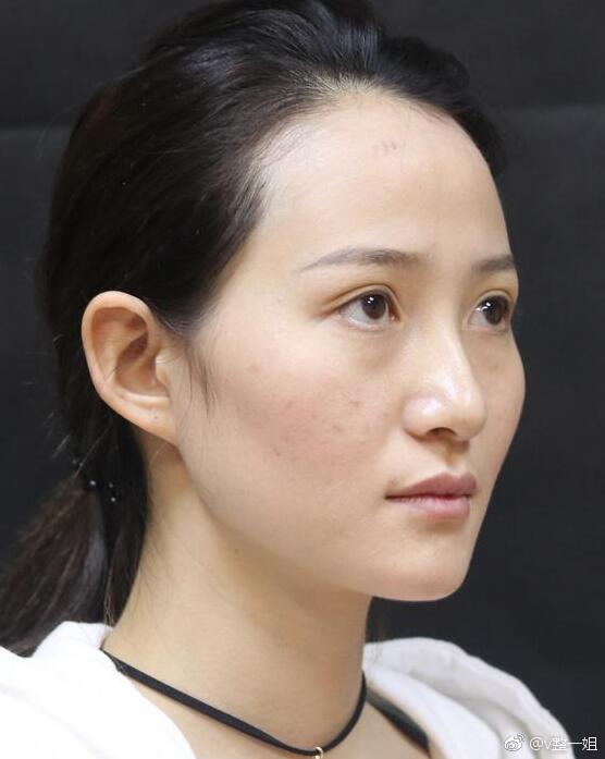 武汉自体脂肪填充全脸,包括太阳穴,额头,苹果肌,下巴.