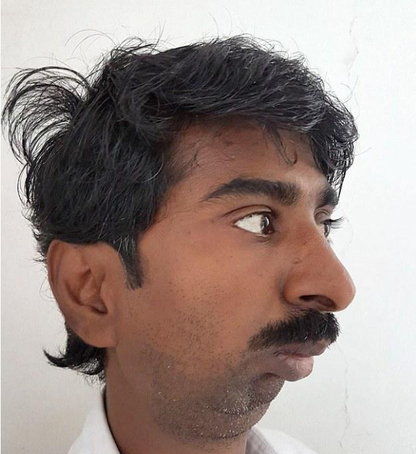 印度男子嘴巴只能张开1.5厘米,从未吃过固体食物,现已手术解决