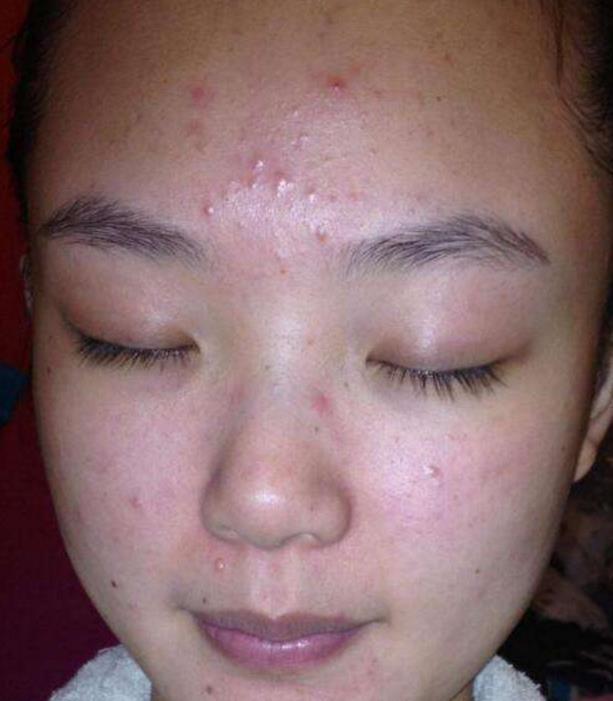 出现这2种明显现象,说明螨虫上亿,1招教你逼退螨虫