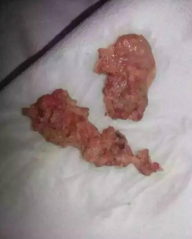 多长时间排完?吃什么可帮助排出恶露?