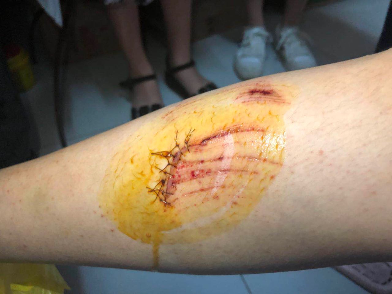 毕业生离校当天踩到学校排水盖盖子塌了脚意外受伤被缝8针