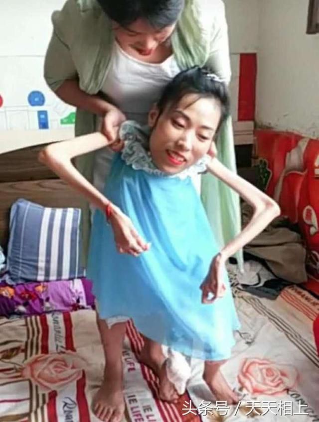 32岁的年龄,却只有16公斤体重,肌肉萎缩的女孩却找到90后