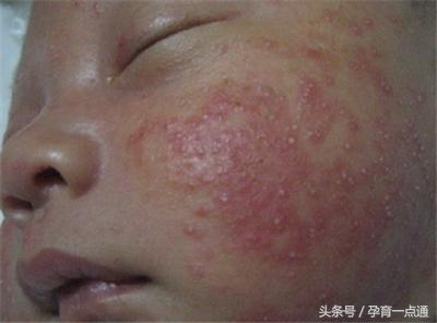 宝宝湿疹跟湿度有关,应对湿疹看这一篇就够了!