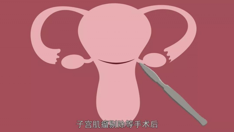 子宫疤痕妊娠不能要孩子?疤痕妊娠究竟是怎么造成的?
