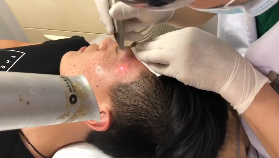 磨削点阵联合自体血清prp治疗凹陷性疤痕之铒激光治疗__财经头条