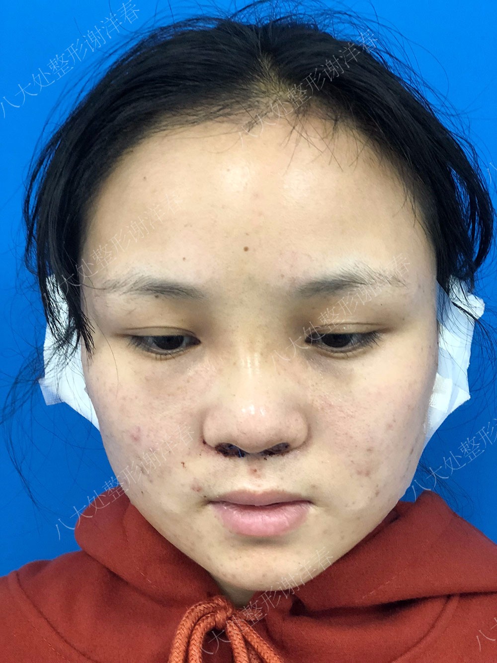 90后小姐姐的鞍鼻改造记(附图)