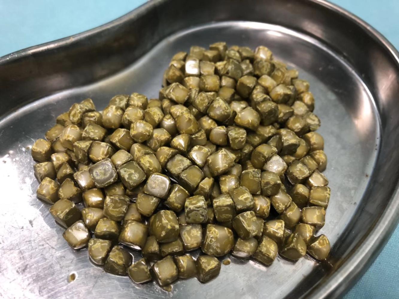 腹痛20年不敢手术郴州女子胆囊内养了258颗结石