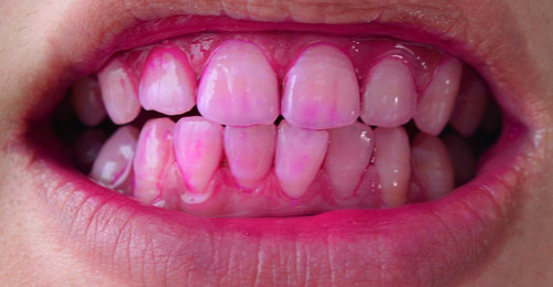 用xnuo心诺声波电动牙刷清洁后,再使用牙菌斑显示剂进行染色可以看出