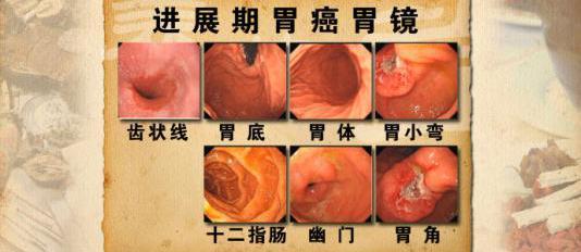 胃癌发病呈年轻化,主要与我们的生活,工作习惯密切相关!