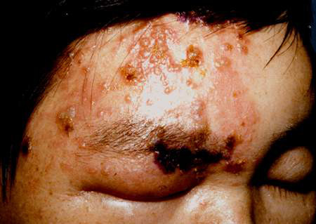 免疫力低下皮肤病图片图片