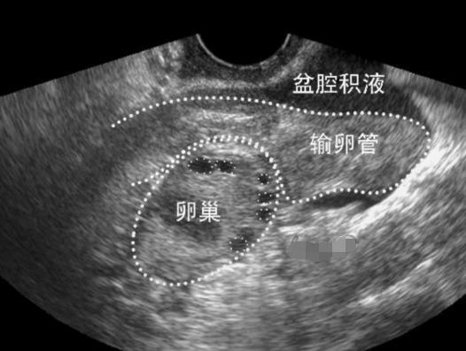 盆腔积液一定会不孕?这种盆腔积液不需要治疗!