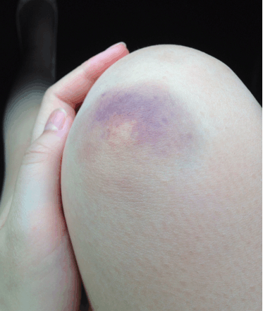 妈妈发现6岁女儿膝盖有不明原因淤青,闹去幼儿园才发现尴尬了