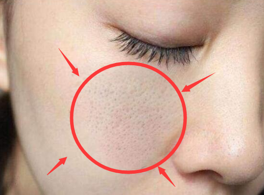 螨虫接二连三在脸上闹腾,会有4个损伤,再不除螨,脸全被吞噬完