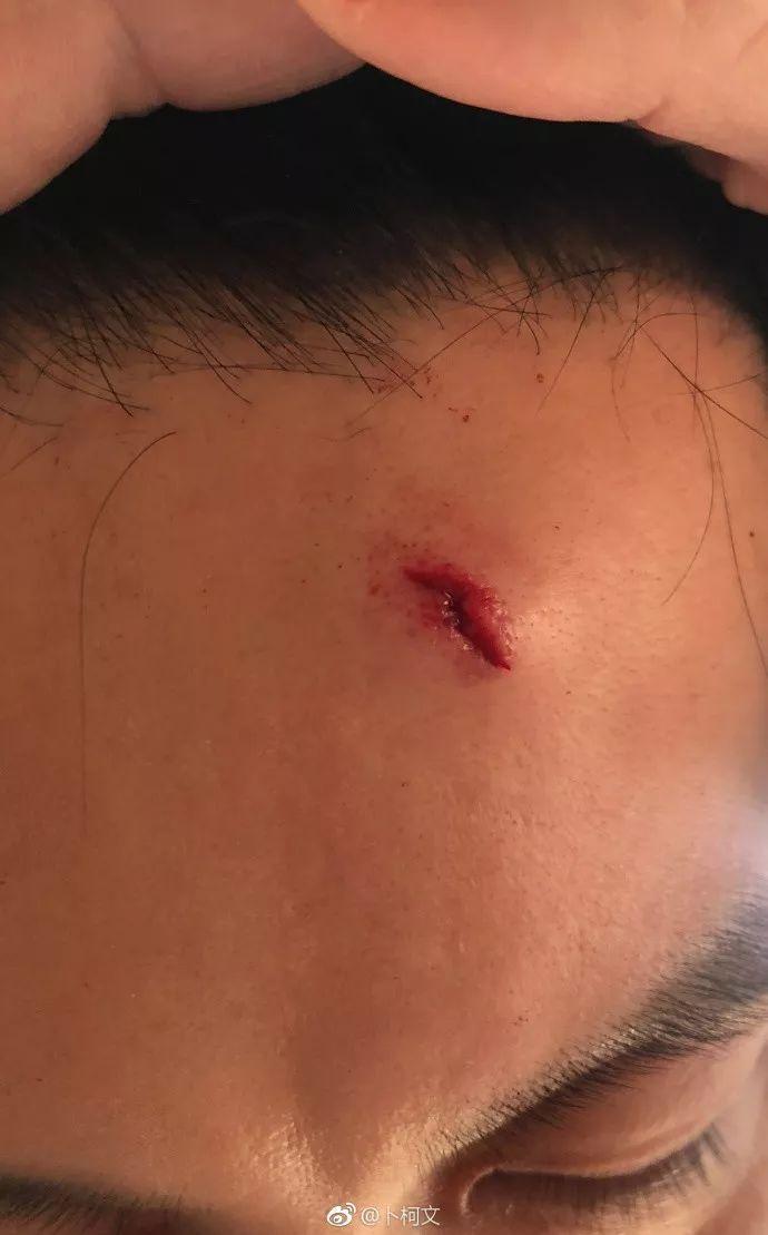 李晨额头受伤缝9针,范冰冰要他纹一个"哈利波特闪电"?