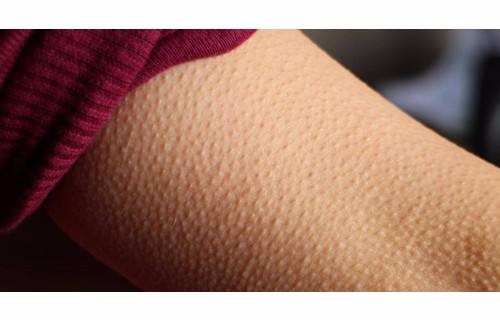 皮肤一摩擦就起鸡皮(全身皮肤痒,抓了过后就像鸡皮一样) 皮肤一摩擦就起鸡皮(全身皮肤痒,抓了过后就像鸡皮一样)