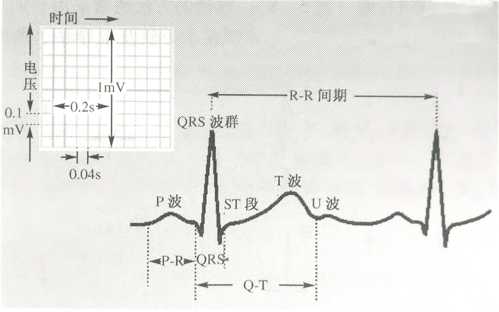 st段压低就一定会是冠心病吗?掌握这几点,让你不再疑惑