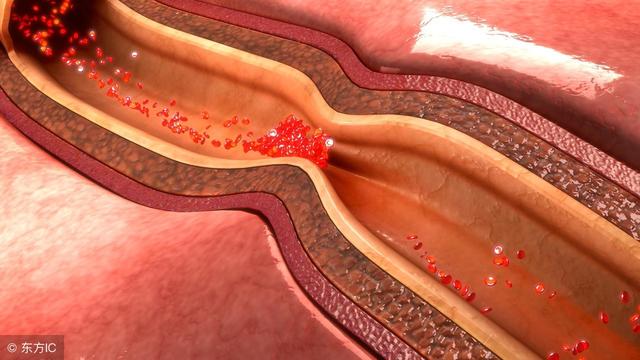 甘油三酯高,做好"三个多",给血管"洗洗澡",血脂恢复正常