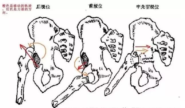 骨科教程:髋关节脱位的复位新方法