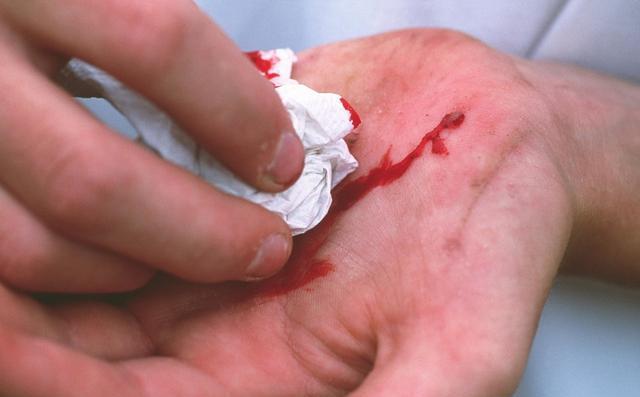 孕妈剖腹1个月伤口崩裂血流不止医生问其原因却难以启齿