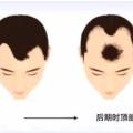 为啥额角和头顶最容易掉发?又该如何治疗呢?|蔓延|额角|脱发_新浪新闻