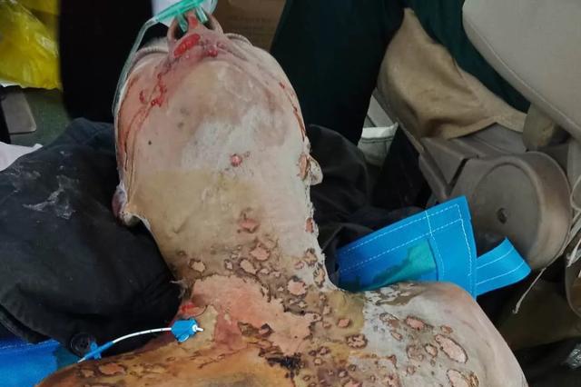 帅小伙被烧成"炭状人" 天价医疗费由谁埋单?