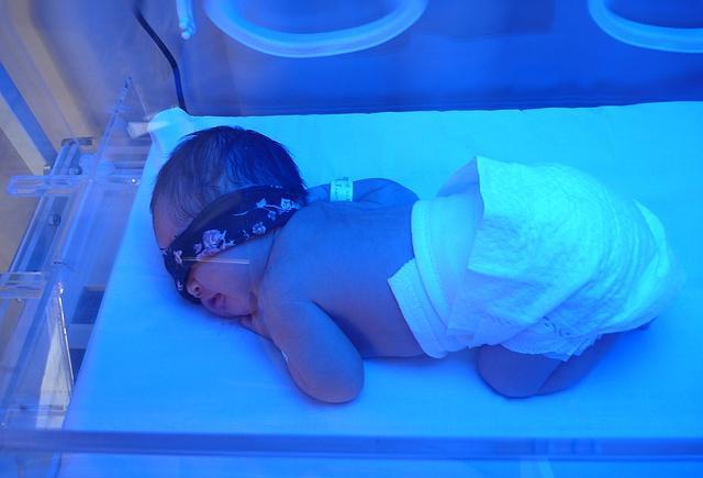 黄疸值多少时需要照蓝光?