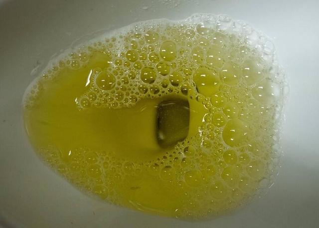 尿分叉别害怕简单的前列腺炎用简单的方法调整