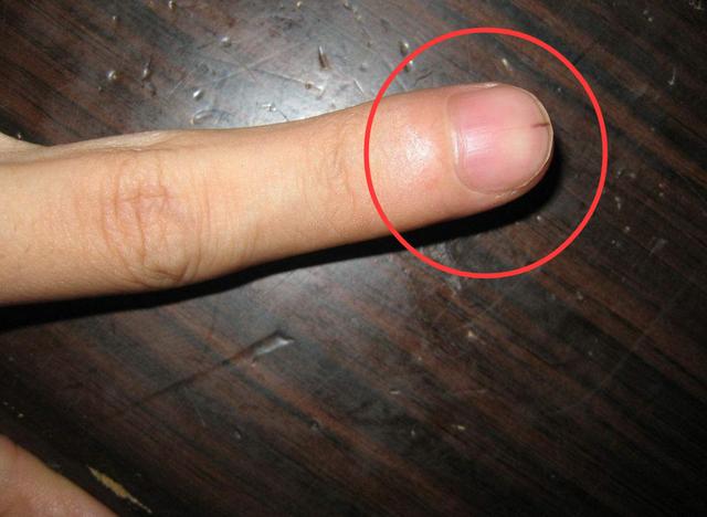 身体出现癌细胞,会有这4个症状,指甲上这个最显眼最好认
