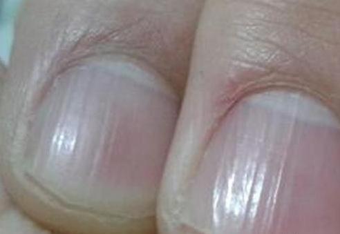 中医认为指甲表面如果出现凸起的棱线,或者是出现凹陷的症状,是肝脏