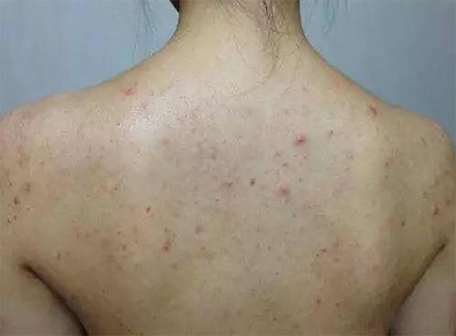 背后痘痘一片一片暗示螨虫数目上万数亿人还以为是湿气重