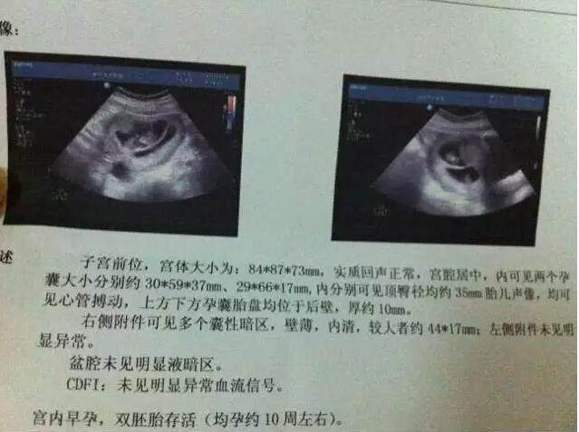 龙凤胎孕囊图片