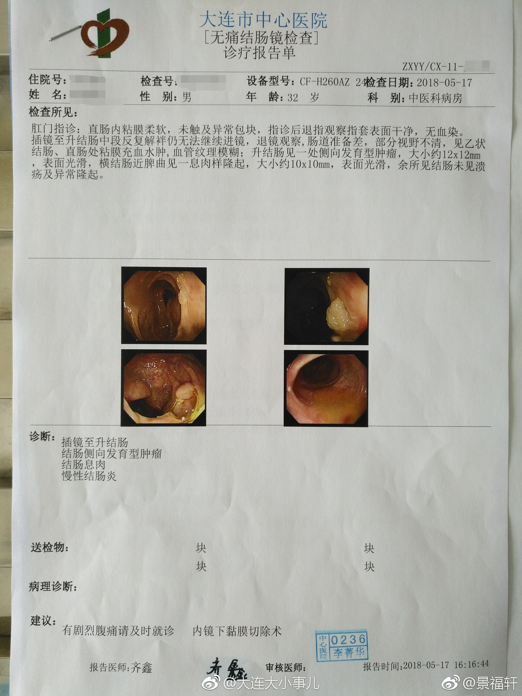 见一处侧向发育肿瘤12x12mm,横结肠近脾曲见一息肉样隆起10x10mm,检查