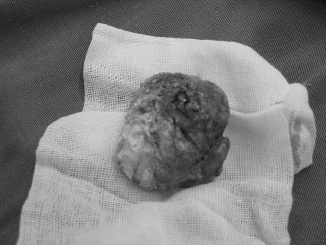 32岁男子耳朵长满"石头",只因痛风没当回事!