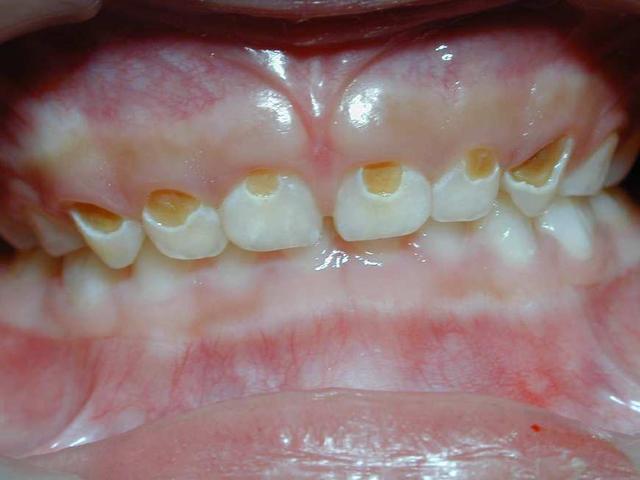 龋齿给宝宝带来这3大坏处,想牙齿健康,一定要掌握正确刷牙方法