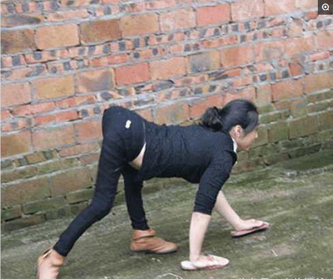 她从一出生就不能直立行走,只能爬着走,现在已经37岁了.